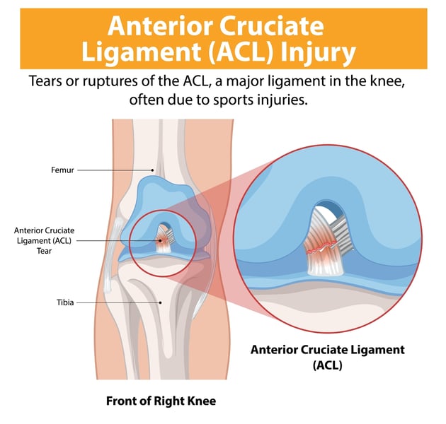 ACL diagram