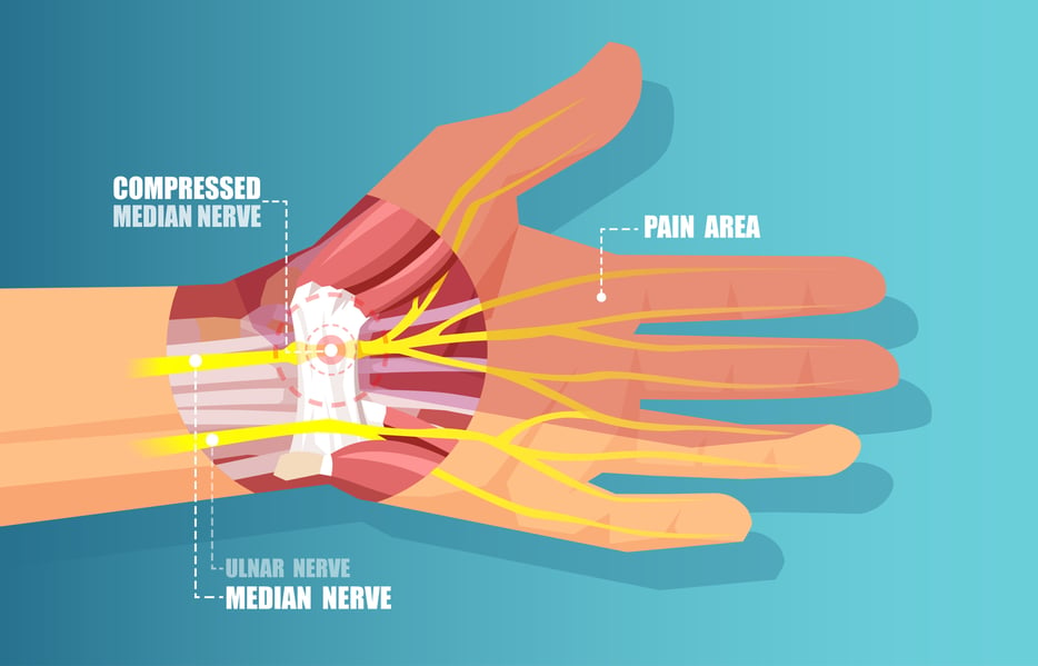 Carpal Tunnel Diagram