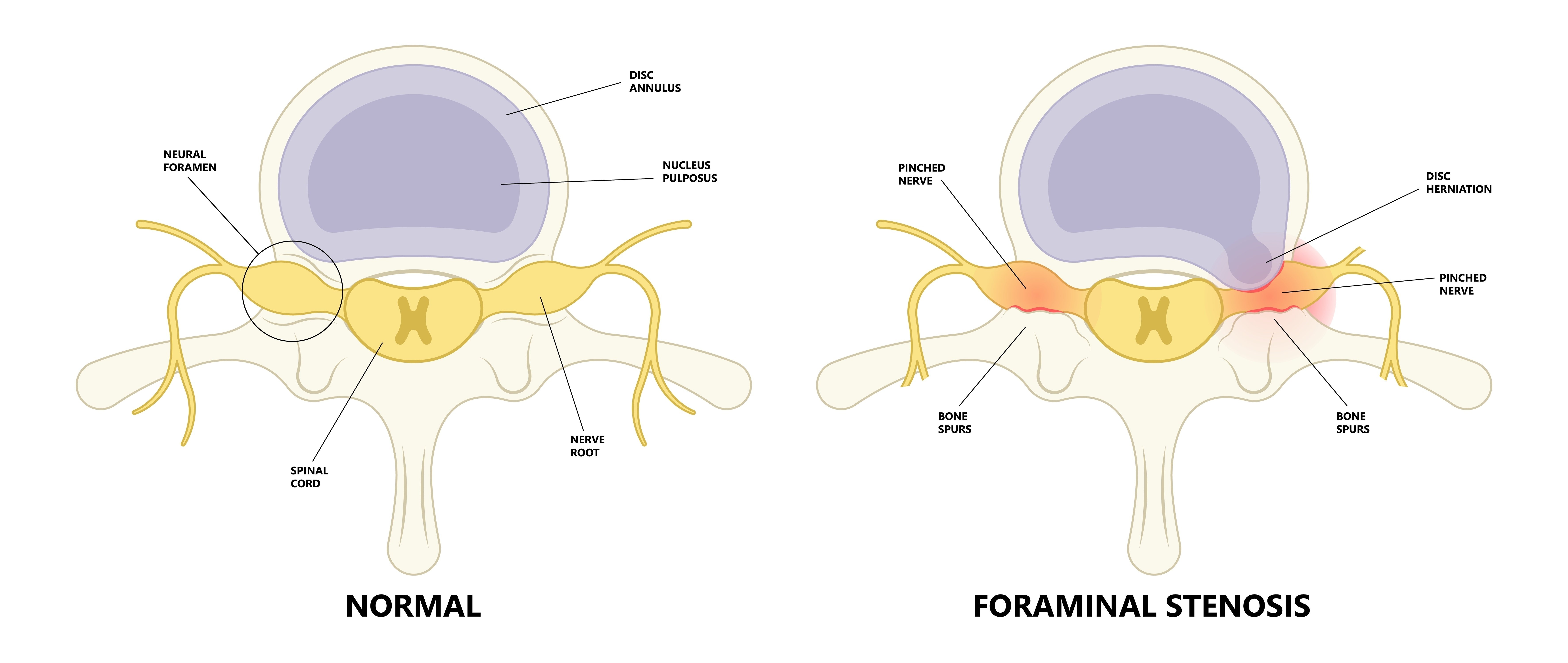 Foraminal stenosis