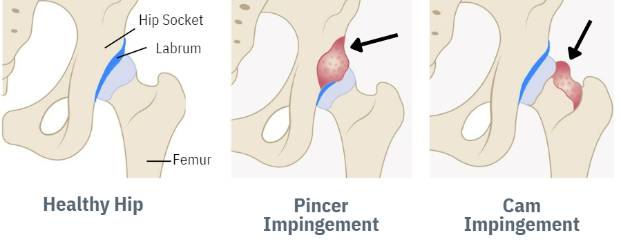 Hip Impingement Picture (updated for article)