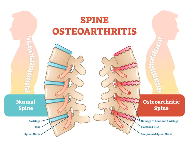 Osteoarthritis of spine