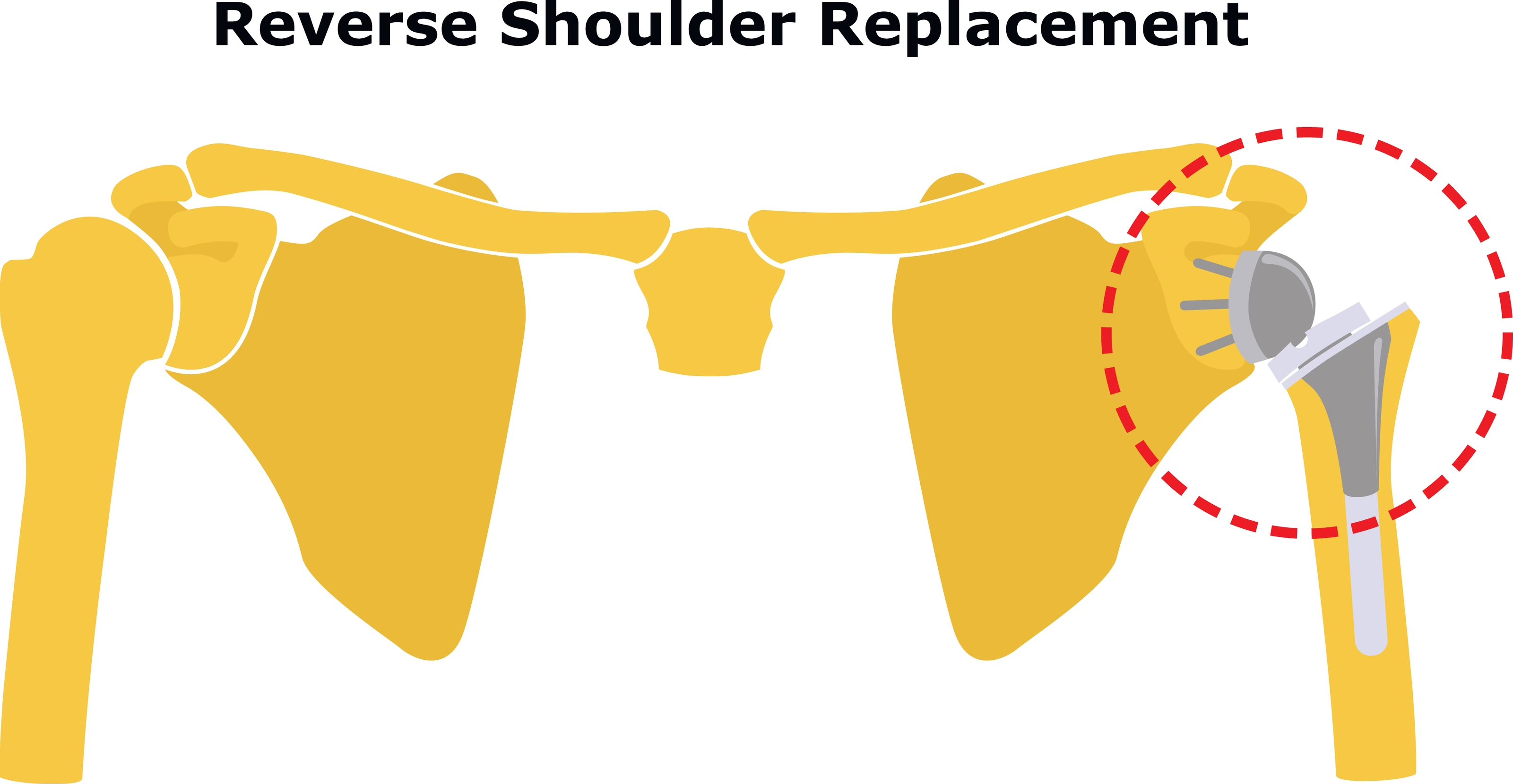 Reverse Total Shoulder