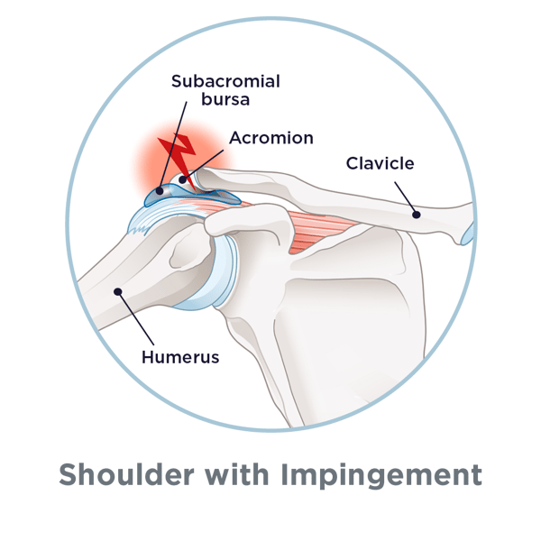 ShoulderImpingement_Graphic2