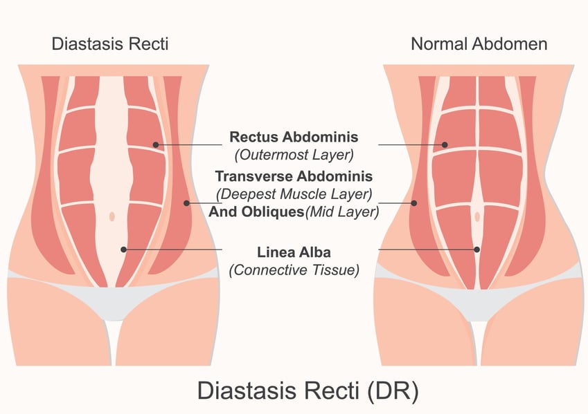 diastasis recti