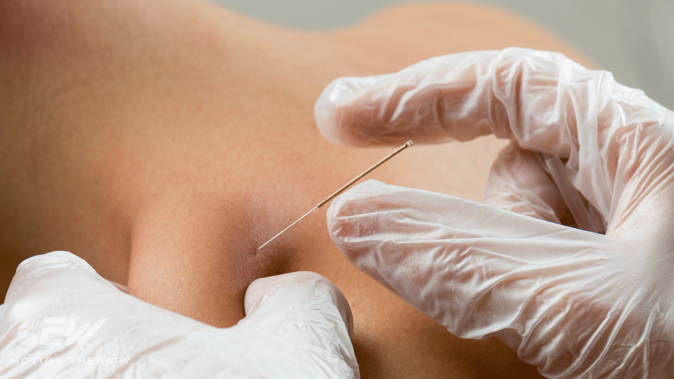 How Long Does It Take for Dry Needling to Work?