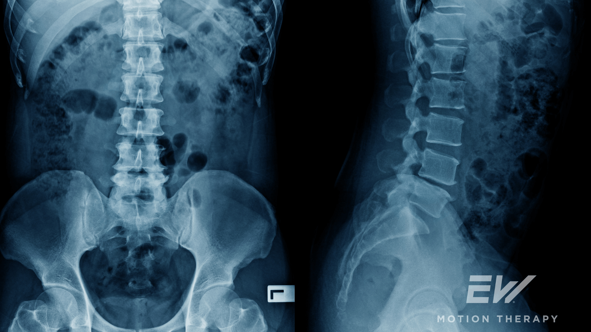 Understanding Spondylolysis in Adolescent Athletes: Causes, Symptoms, and Treatment Options